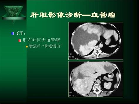 肝長東西|肝臟長東西 不一定是「歹咪呀」